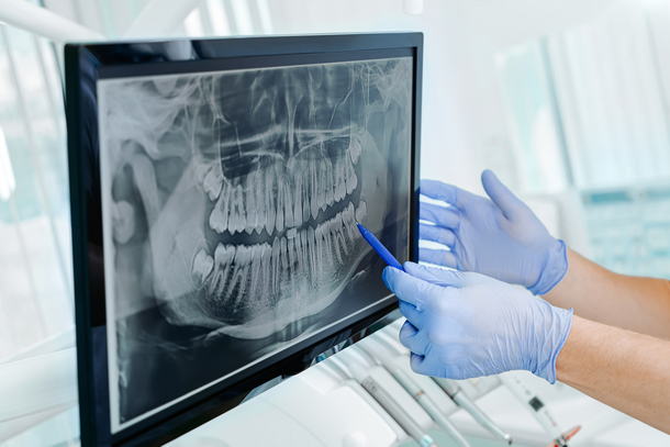 Dental X-Ray