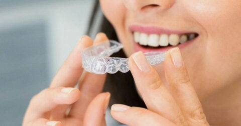 Invisalign clear braces