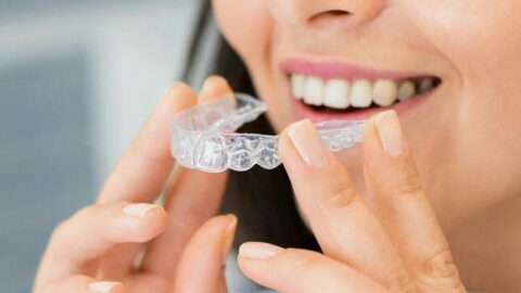 Invisalign clear braces